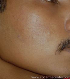 Acne-PIH-After